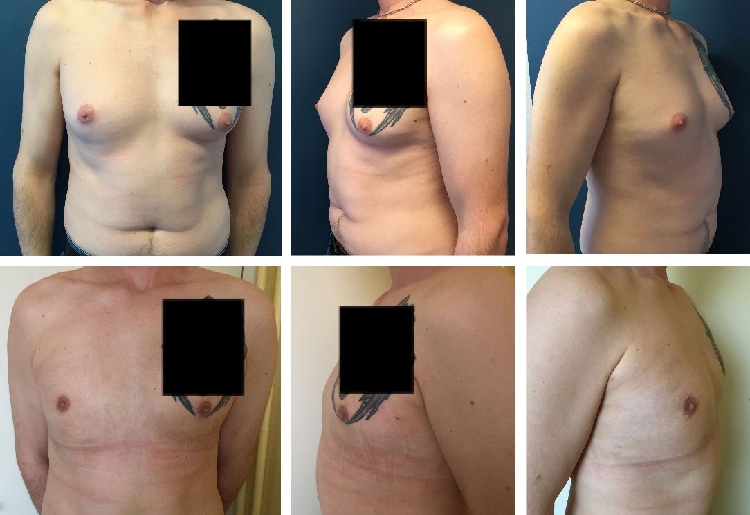 Photos avant / après d'opération de gynécomastie (seins chez l'homme) à Metz par le docteur De Runz