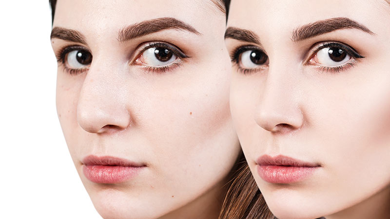 Rhinoplastie à Metz - Chirurgien esthétique Antoine De Runz