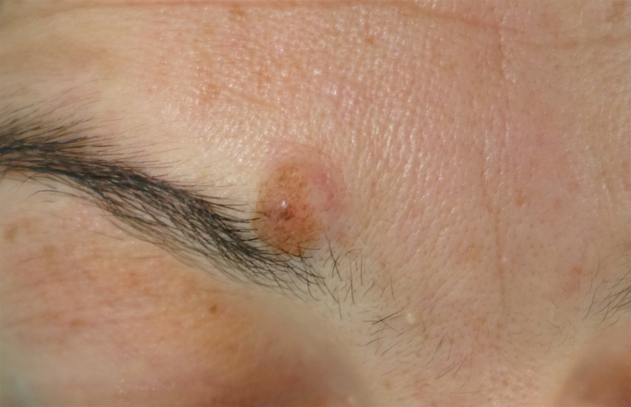 Retirer un naevus, lipome ou un kyste à Metz