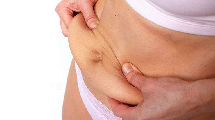 Quelle est la différence entre une lipoaspiration et une abdominoplastie ?