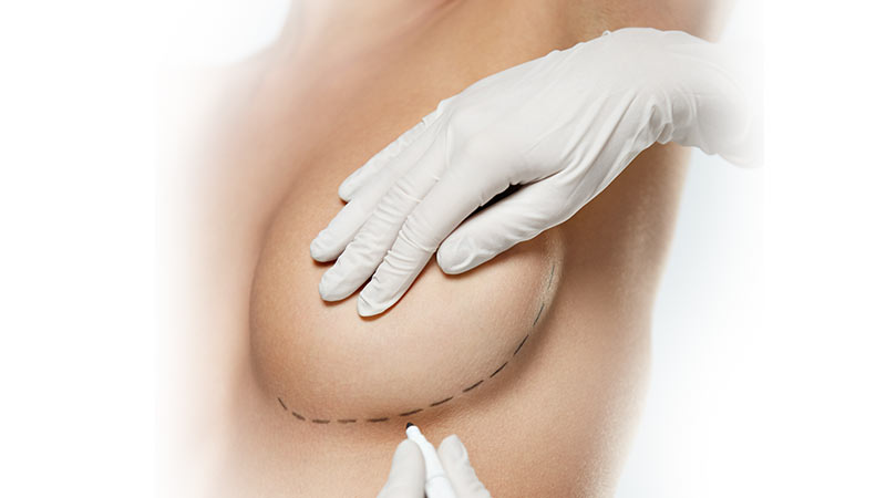 Lifting des seins à Metz - Docteur Antoine De Runz