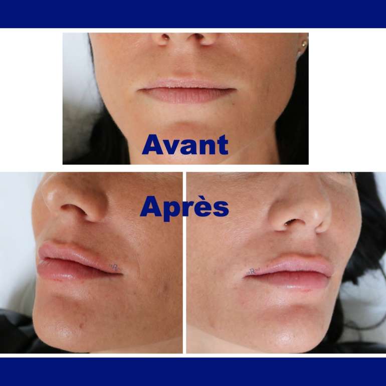 Dr Antoine De Runz Chirurgien Esthétique Metz Lorraine