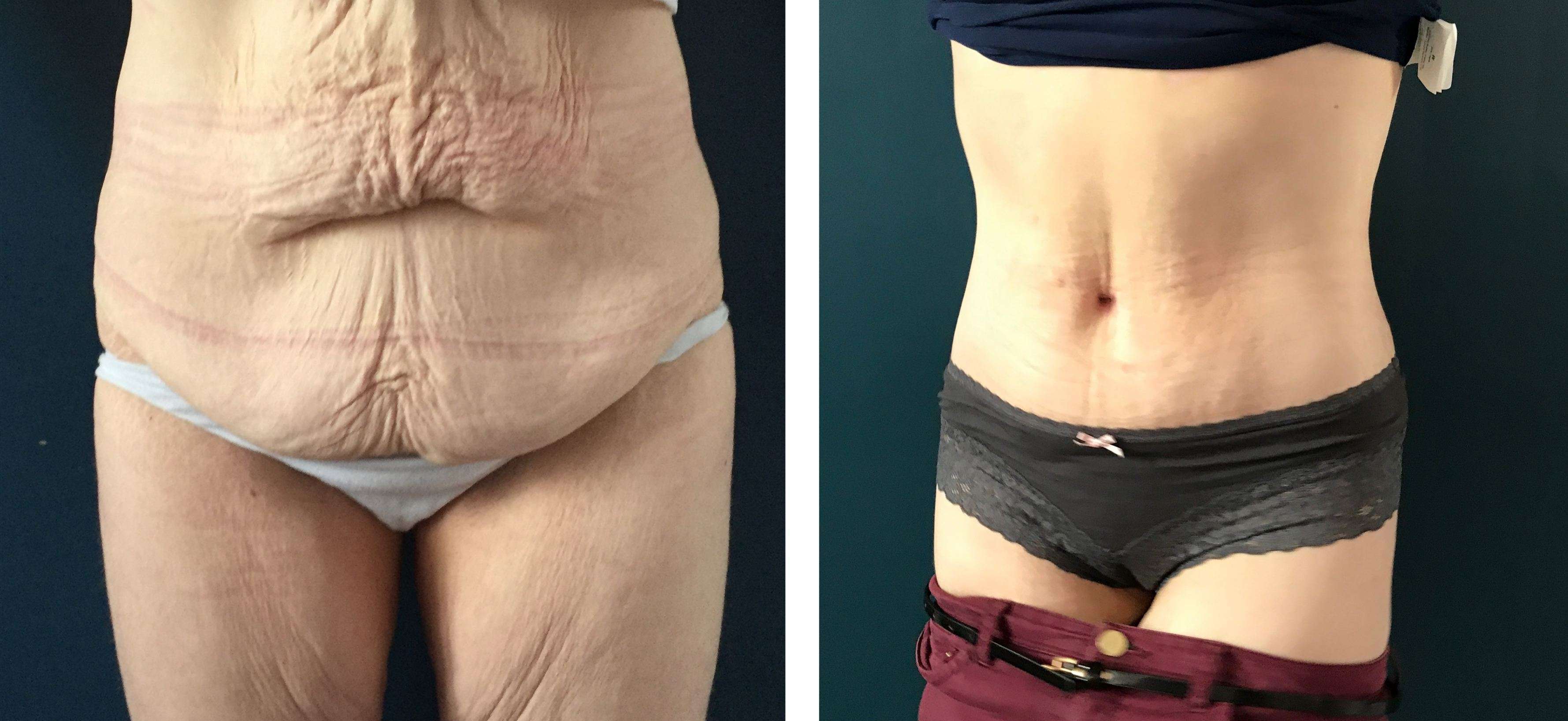 Photos avant/après de Bodylift à Metz - Docteur De Runz