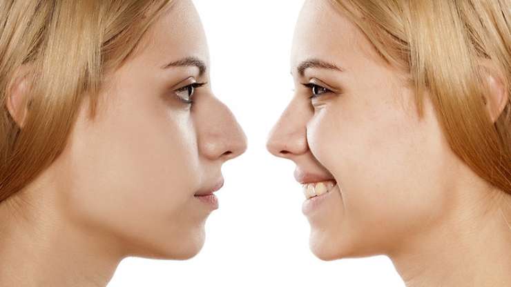 Perception Sociale de la Rhinoplastie