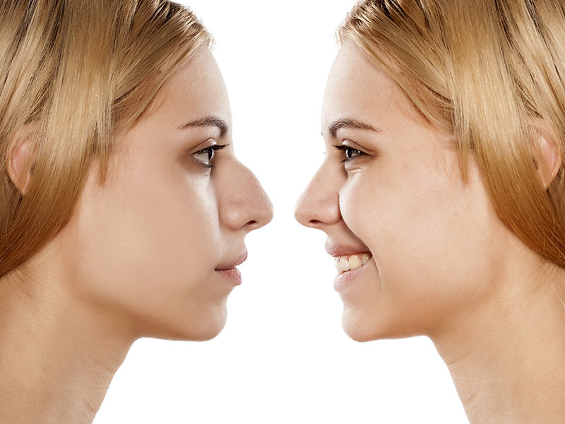 Perception Sociale de la Rhinoplastie