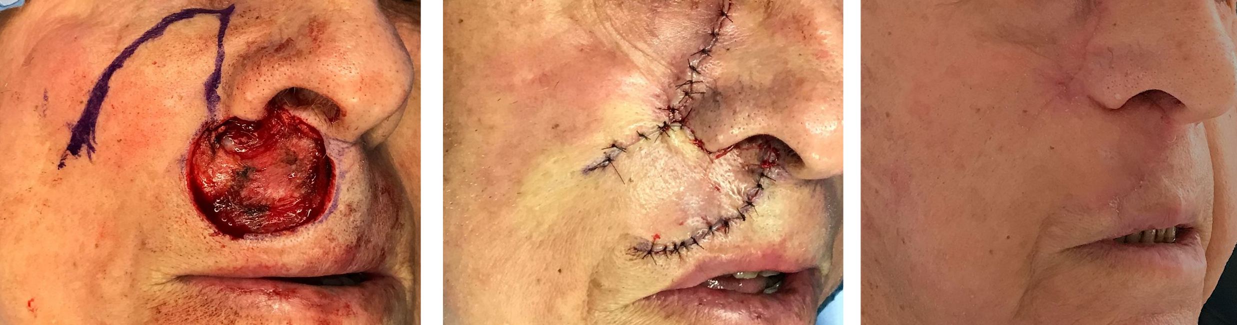 Reconstruction faciale à Metz par le docteur Antoine De Runz